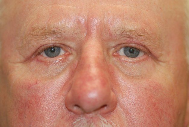 After eyelid surgery