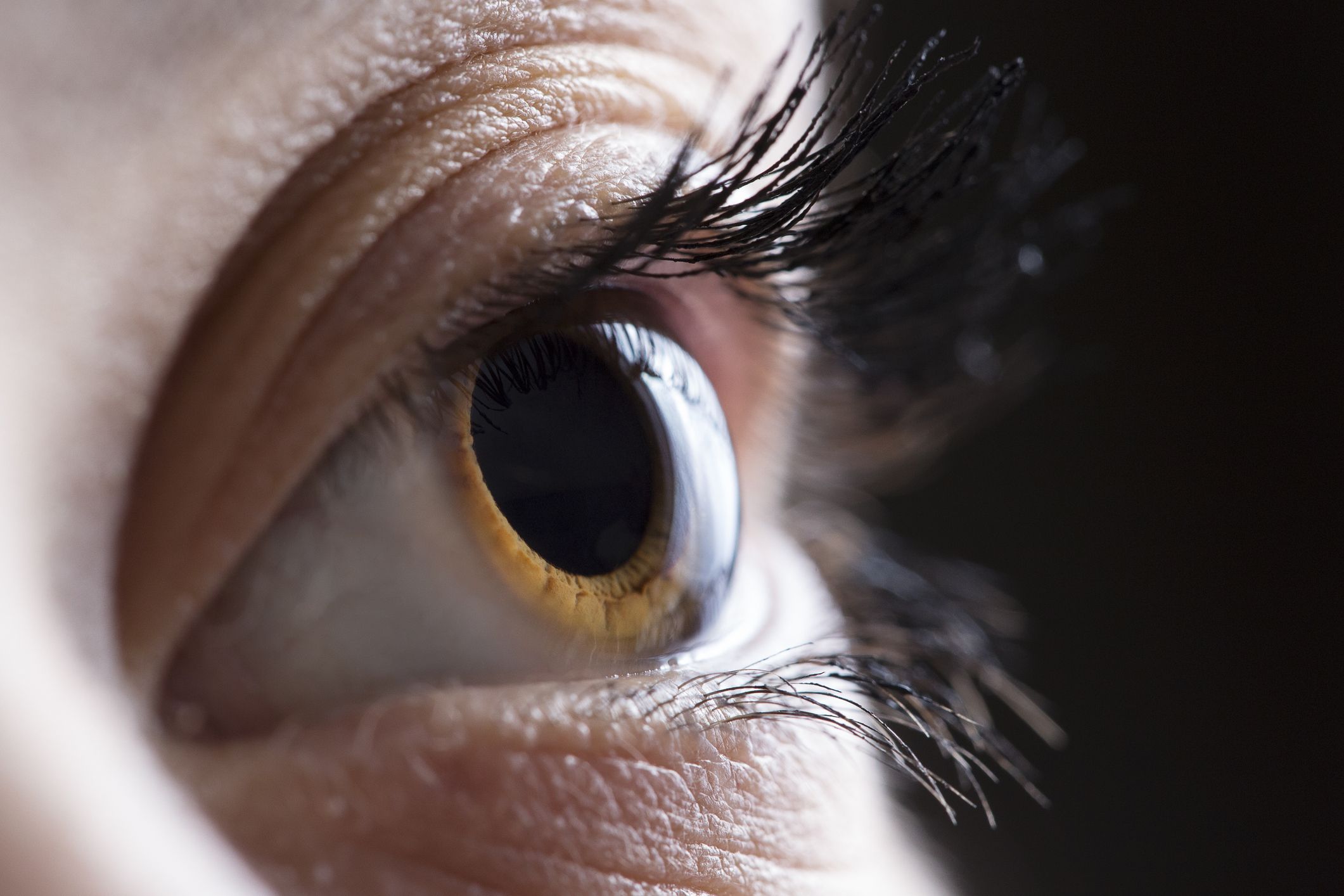 Brown eye – Steven J. Covici, MD, FACS